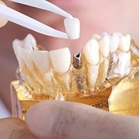 Model of smile with implant supported crown