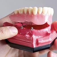 Model implant retained dentures
