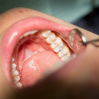 Closeup of teeth during dental treatment